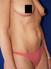 Tummy Tuck Before & After