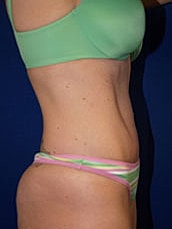 Tummy Tuck Before & After