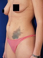 Tummy Tuck Before & After