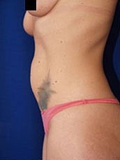 Tummy Tuck Before & After