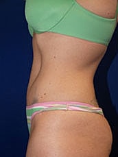 Tummy Tuck Before & After