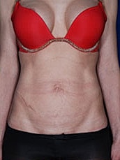 Tummy Tuck Before & After