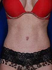 Tummy Tuck Before & After