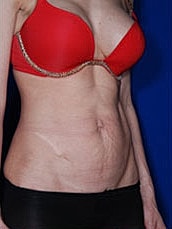 Tummy Tuck Before & After