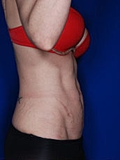 Tummy Tuck Before & After