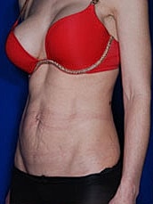 Tummy Tuck Before & After