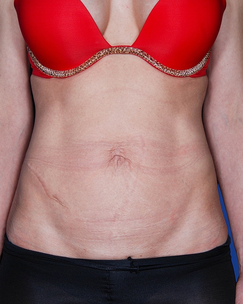 Tummy Tuck Before & After