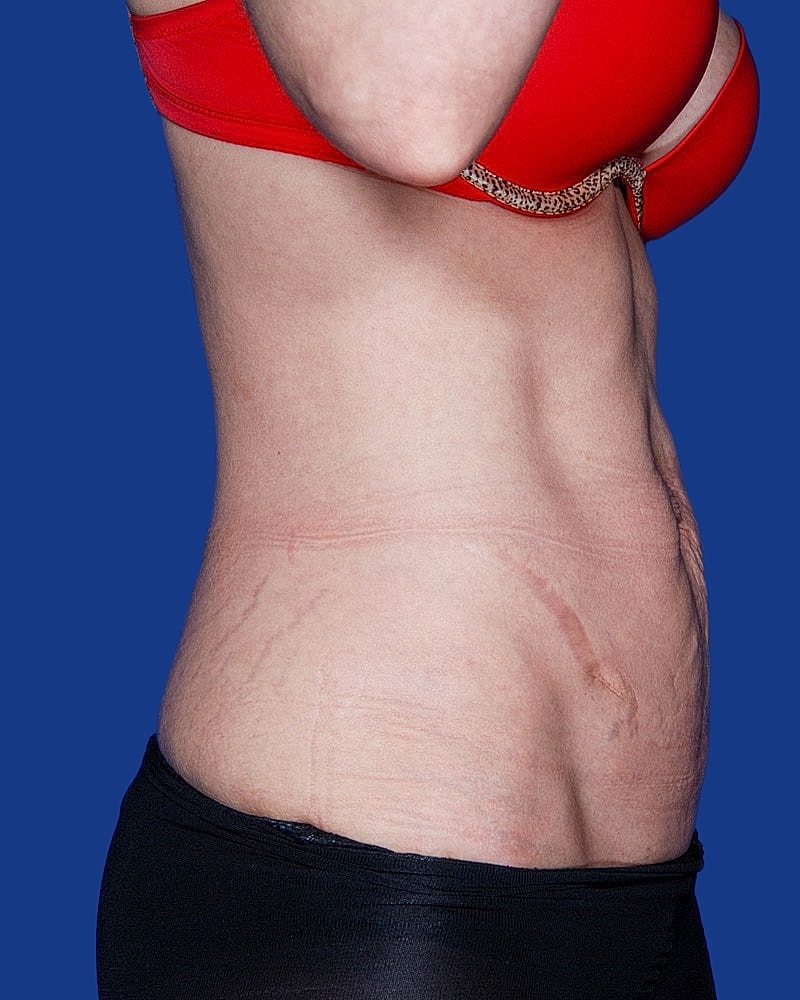 Tummy Tuck Before & After