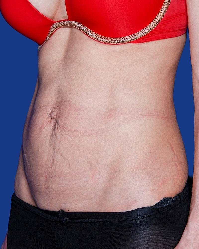 Tummy Tuck Before & After