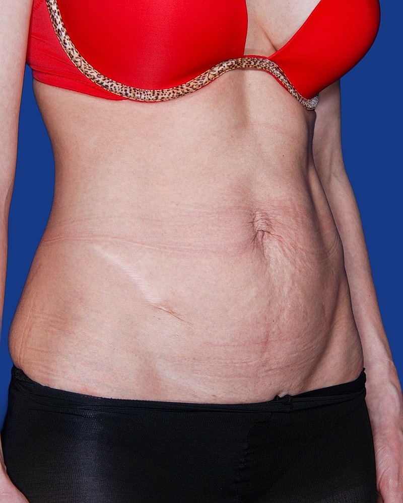 Tummy Tuck Before & After