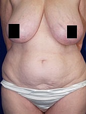 Tummy Tuck Before & After