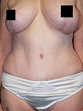 Tummy Tuck Before & After