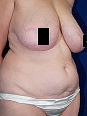 Tummy Tuck Before & After