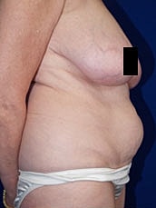 Tummy Tuck Before & After
