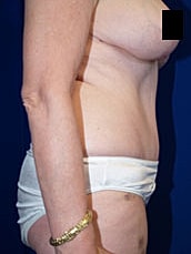 Tummy Tuck Before & After