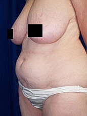 Tummy Tuck Before & After