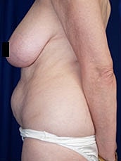 Tummy Tuck Before & After