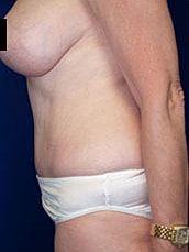 Tummy Tuck Before & After