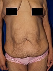 Tummy Tuck Before & After