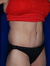 Tummy Tuck Before & After