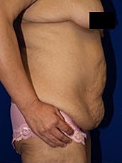 Tummy Tuck Before & After