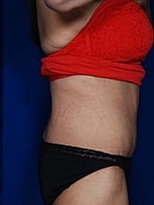 Tummy Tuck Before & After