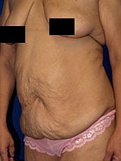 Tummy Tuck Before & After