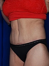 Tummy Tuck Before & After