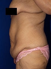 Tummy Tuck Before & After