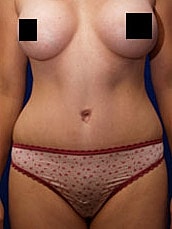 Tummy Tuck Before & After