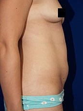 Tummy Tuck Before & After