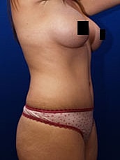 Tummy Tuck Before & After