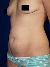 Tummy Tuck Before & After