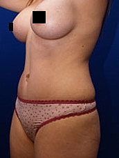 Tummy Tuck Before & After