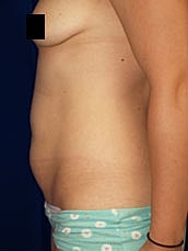 Tummy Tuck Before & After