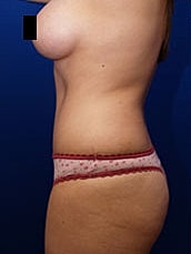 Tummy Tuck Before & After