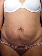 Tummy Tuck Before & After