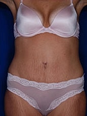 Tummy Tuck Before & After
