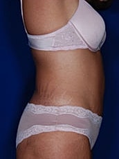 Tummy Tuck Before & After