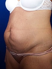 Tummy Tuck Before & After