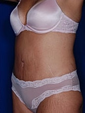 Tummy Tuck Before & After