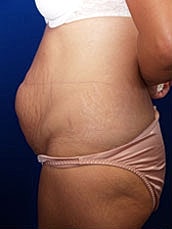 Tummy Tuck Before & After
