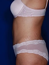 Tummy Tuck Before & After