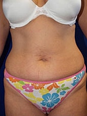 Tummy Tuck Before & After