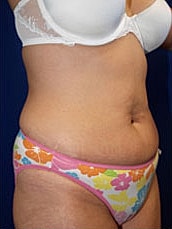 Tummy Tuck Before & After