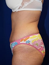 Tummy Tuck Before & After