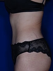 Tummy Tuck Before & After