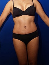 Tummy Tuck Before & After