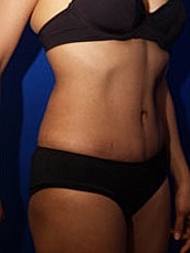 Tummy Tuck Before & After
