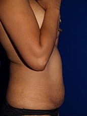 Tummy Tuck Before & After